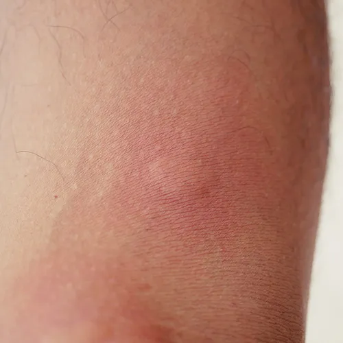 traitement punaise de lit NANTES RéZé CHATEAUBRIAND LOIRE ATLANTIQUE SAPA